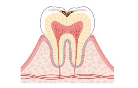 大きい虫歯