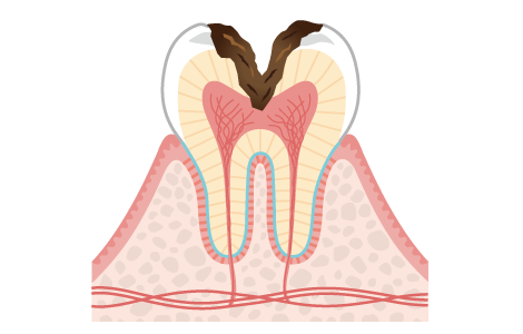 かなり大きい虫歯